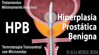 Hiperplasia Prostática Benigna HPB y Tratamientos Alila Medical Media Español [upl. by Ainniz]