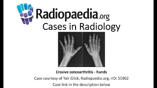 Erosive osteoarthritis Radiopaediaorg Cases in Radiology [upl. by Notniuqal463]