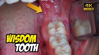 Removal of horizontal impacted wisdom tooth  Odontectomy  Dentist  Dokter Gigi Tri Putra [upl. by Rodmann]