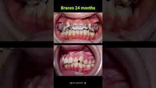 24 months Braces Transformation ‼️👏 dentalcare satisfying dentist dentalhealth shorts [upl. by Vivienne]