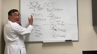 OCT in papilledema [upl. by Ligetti]