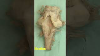 Facial colliculus Rhomboid fossa neuroanatomy brain brainstemrhomboidfossa [upl. by Erodisi]