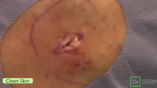 How to removal blackhead 2019 [upl. by Junette]