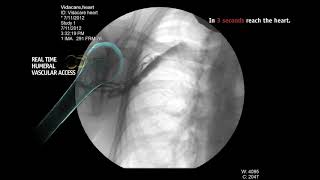 Intraosseous Infusion From Right Humeral Head [upl. by Anived]