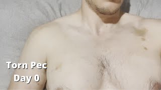 Torn Pec from BJJ  Pec Tear [upl. by Anipsed]