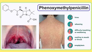 phenoxymethylpenicillin [upl. by Hoo]