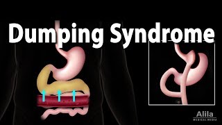 Dumping Syndrome Animation [upl. by Stauffer715]