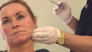 Full face filler treatment  nonsurgical volumetric facelift [upl. by Accber174]