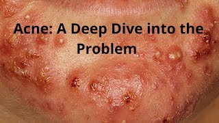 Acne A Deep Dive into the Problem [upl. by Ailana]