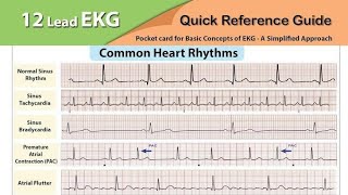 Understanding ECG Findings A Comprehensive Guide [upl. by Thetisa]