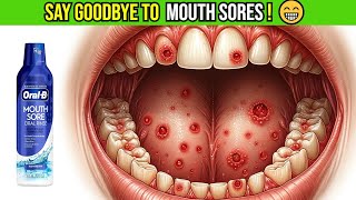 Say Goodbye to Mouth Sores 😁 OralB Mouth Sore Mouthwash with Hydrogen Peroxide Review🌟 [upl. by Ahsok]