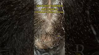 Lice nits removal treatment  lice treatment  lice removal  lice how to remove the nits from hair [upl. by Flann]