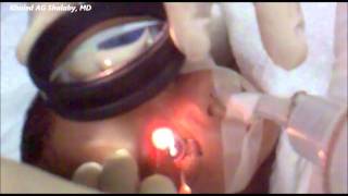 Laser Treatment of Retinopathy of prematurity ROP [upl. by Aubine901]