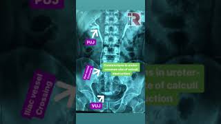 Intravenous urography anatomy pearls shorts anatomy radiology youtube [upl. by Oisorbma]