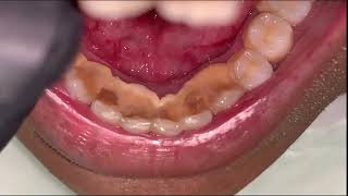 Limpieza de Sarro Dental Supragingival y Subgingival [upl. by Aimar194]