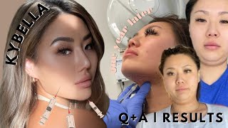 KYBELLA QA  1 year later recap  WELCOME BACK to my new beauty blog kybella kybellaresults [upl. by Inavoy]