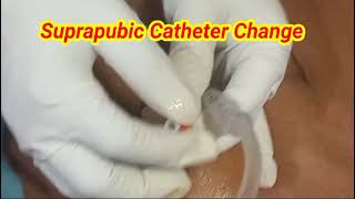 suprapubic Urine Catheter change savelifesdeepartha [upl. by Aubrette572]