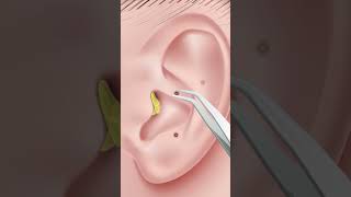 ASMR Ear Cleaning Animation  Oddly Satisfying ear stone removal  shorts [upl. by Garry752]