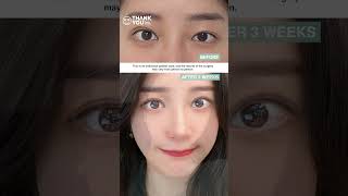 shortvideo Thank You Plastic Surgery Correct your asymmetrical eyes with just one procedure [upl. by Kenny]