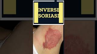 5 Types of Psoriasis You Do Not Know  Shorts [upl. by Denni]