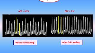 PRACTICAL USE OF HEART LUNG INTERACTIONS TO ASSESS HAEMODYNAMIC STATUS Teboul JL 2015 [upl. by Cleodel]