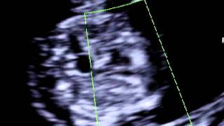 Fetal heart scan at 11 weeks of pregnancy [upl. by Anir]