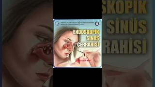 Endoskopik Sinüs CerrahisiEndoscopic Sinus Surgery [upl. by Murdock128]