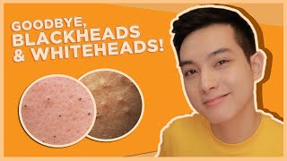 BEST SKINCARE for BLACKHEADS amp WHITEHEADS OPEN amp CLOSED COMEDONES  Jan Angelo [upl. by Aitselec]