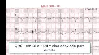 Discussão de ECG 1 [upl. by Pepita]