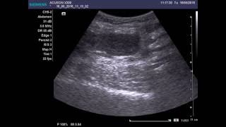 Liposarcoma of soft tissues [upl. by Ahsenrad]