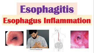 Esophagitis Esophagus Inflammation Causes Risk Factors Signs and Symptoms Diagnosis Treatment [upl. by Nafis]