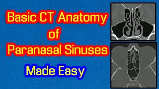 Basic CT Anatomy of Paranasal Sinuses Made Easy [upl. by Wallache]