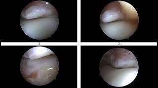 Osteocondritis disecante y pinzamiento de tobillo [upl. by Yebot809]