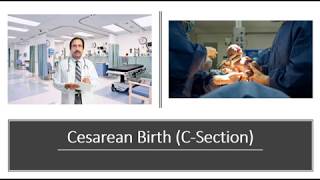 Cesarean Birth CSection [upl. by Belden]