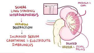 Hydronephrosis  Renal Pathology  Osmosis [upl. by Haskins]