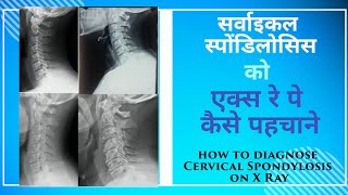 सर्वाइकल स्पोंडिलोसिस की एक्सरे पे पहचान How is cervical spondylosis identified on XRays [upl. by Katleen631]