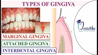 Gingiva anatomy  Gingiva types  Carranza  Marginal Attached amp Interdental Gingiva Periodontology [upl. by Lucky486]