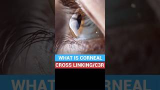 Corneal cross linking C3R  Keratoconus Treatment Cost [upl. by Gilbertson]