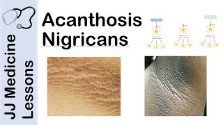 Acanthosis Nigricans  Risks Pathogenesis and Treatments [upl. by Mun]