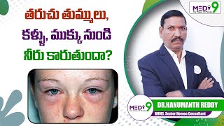 తరుచు తుమ్ములు కళ్ళు ముక్కు నుండి నీరు  Allergic Rhinitis Symptoms  Dr Hanumanth Reddy  Medi9 [upl. by Ecnatsnok]