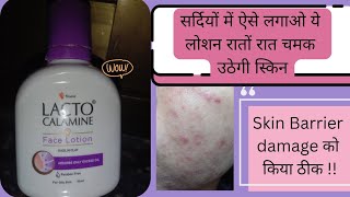 lacto calamine face lotion lacto calamine lotion for acne prone skin reviewlacto calamine lotion [upl. by Wharton602]