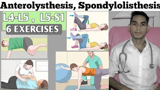 Anterolisthesis spondylolisthesis l4 L5s1 exercise treatment Low back pain exercises Disc bulged [upl. by Carole]