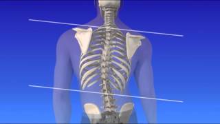 Scoliosis  Curvature of the Spine [upl. by Ij]