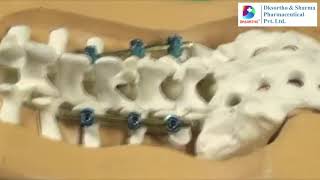 Pedicle Screw Spine fixation surgical technique DKSORTHO [upl. by Pressey]