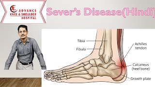 Severs Disease Hindi [upl. by Aihsein]