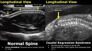 Fetal Spine Ultrasound Normal Vs Abnormal Image Appearances  Spinal Abnormalities  Obstetric USG [upl. by Maleki240]