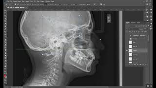 Cephalometrics Part 5 المرحلة الخامسة [upl. by Wilie128]