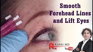 How to Smooth Forehead Lines and Lift Brows with PDO Threads Portland Oregon [upl. by Selegna690]