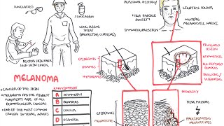 Melanoma  Overview signs and symptoms pathology risk factors treatment [upl. by Vidda]