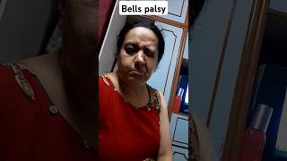 Bells palsy bellspalsy paralysis facialparalysis recover doctor treatment shots physiotherap [upl. by Acirre891]